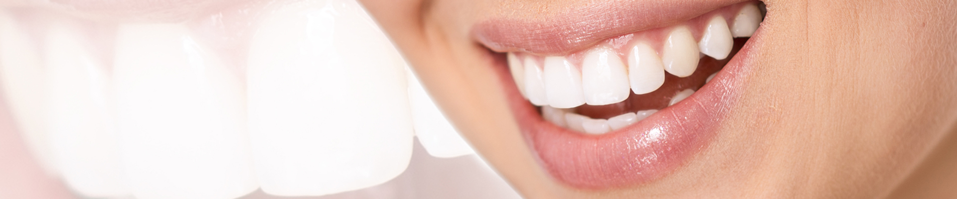 Types of Teeth Whitening Methods